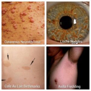 نوروفیبروماتوز 