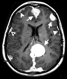 نوروفیبروماتوز 